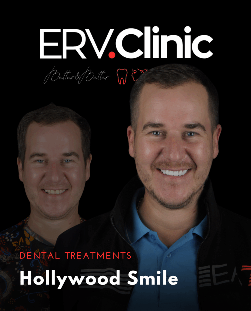 Hollywood Smile DENTAL TREATMENTS (2)
